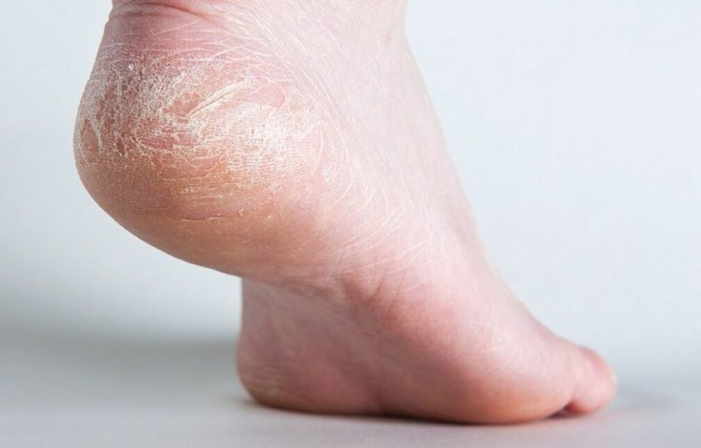 ādas sēnīte uz kājas kā ārstēt