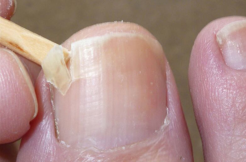 Bojāti nagi ir sēnīšu infekcijas riska faktors