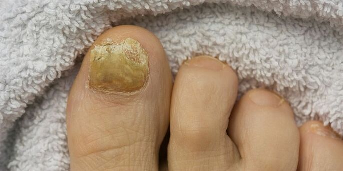 dzeltenais kāju nagu ar sēnīšu infekciju