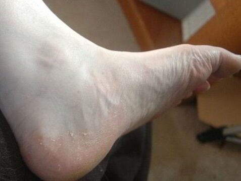 kājas pēdas pīlings kā sēnīšu infekcijas pazīme